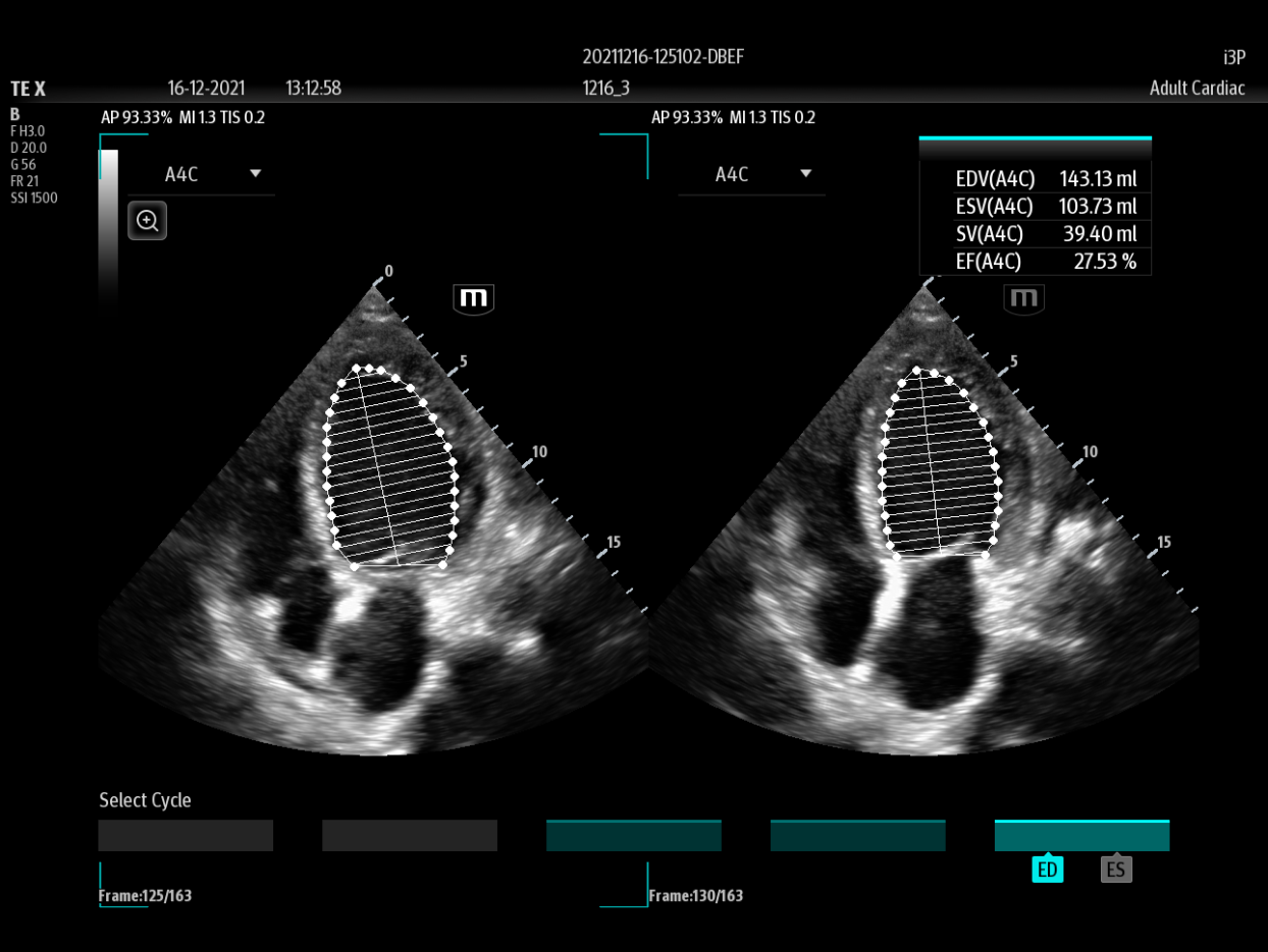 i3P_4C_Mitral stenosis_Auto EF_1-1244x935